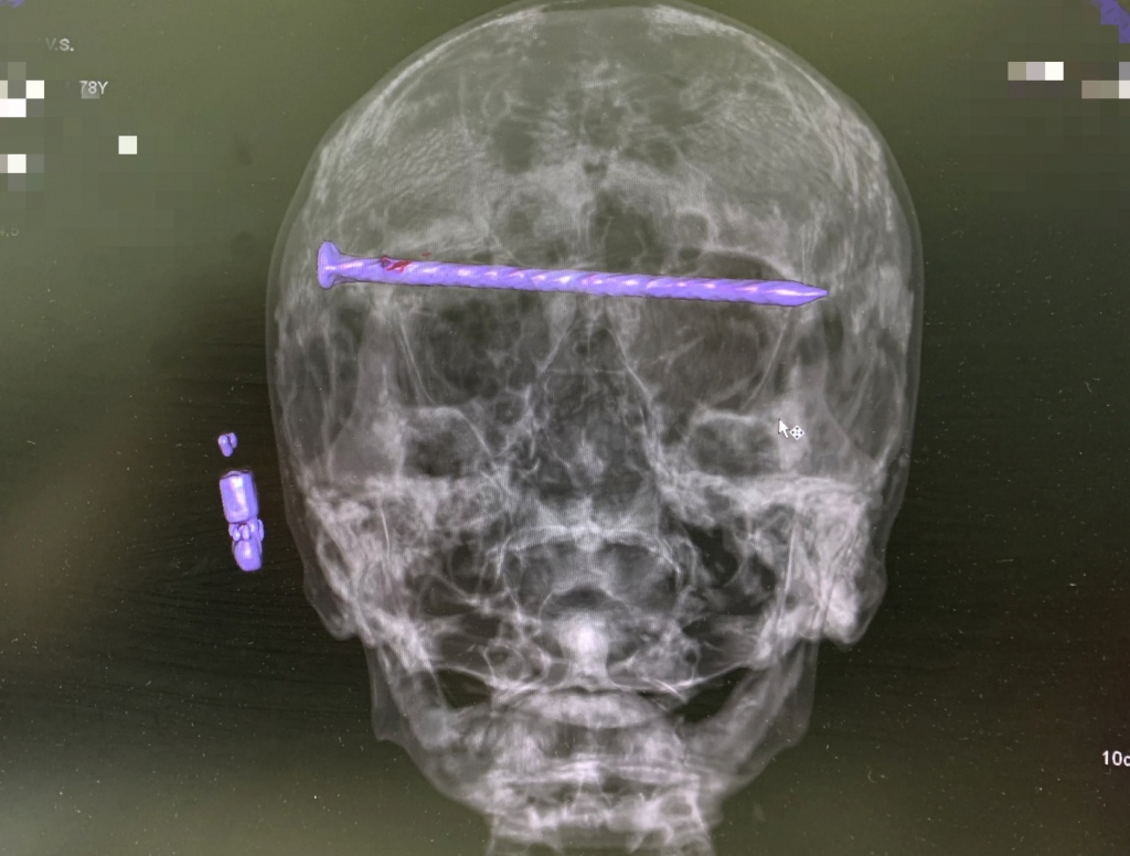 Тагильские нейрохирурги спасли жизнь мужчине, у которого в черепе был 15-сантиметровый гвоздь