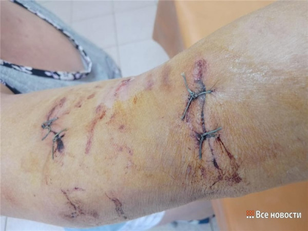 В пригороде Нижнего Тагила собака напала на женщину и едва не отгрызла ей руку