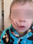 В Нижнем Тагиле родители изувеченного в частном детском саду мальчика обвинили директора в попытке уйти от материальной ответственности