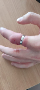 В Нижнем Тагиле спасатели Центра защиты помогли мужчине снять кольцо с опухшего пальца В Нижнем Тагиле спасатели Центра защиты помогли мужчине снять кольцо с опухшего пальца